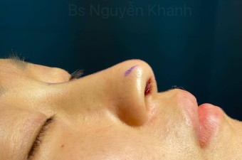 Phương pháp nâng mũi nào thích hợp cho dáng mũi cao nhưng chóp mũi lại thấp