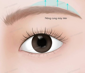 Phân biệt 2 phương pháp nâng cung mày: treo bờ trên và treo bờ dưới