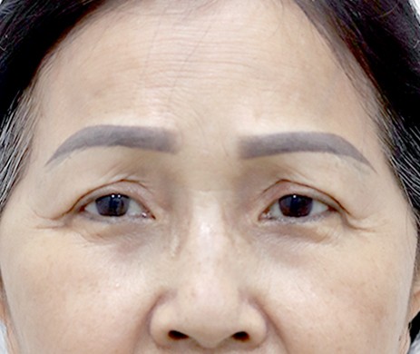 Treo Cung Mày