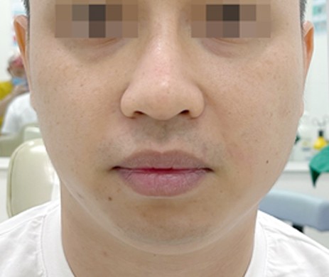 Độn Cằm Nam