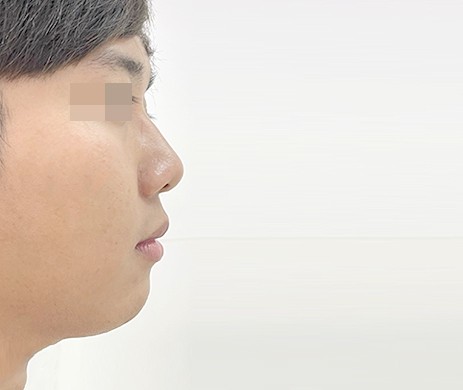 Độn cằm