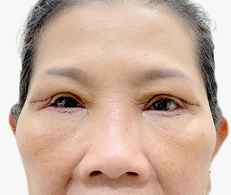 Cắt mí trên – Cấy mỡ mí dưới