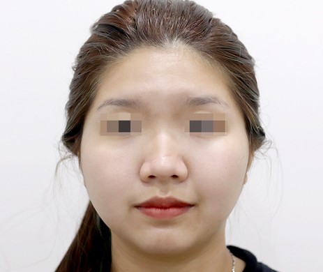 Mũi lót sụn – Cà gồ