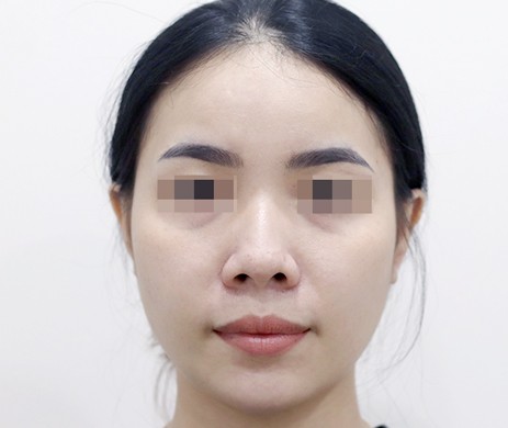 Mũi lót sụn – Cà gồ- Cắt cánh mũi – Thu chóp
