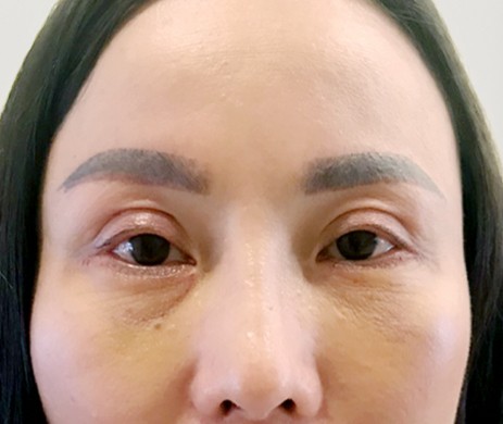 Cắt mí dưới