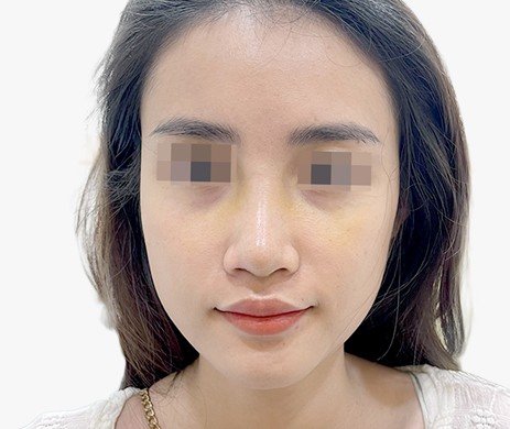 Mũi lót sụn