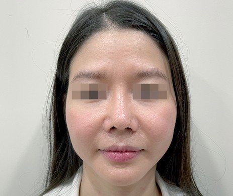 Mũi cấu trúc sụn sườn sửa lại – Cắt xương – Cắt cánh cánh mũi