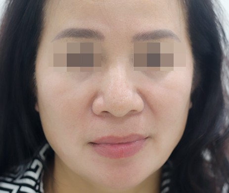 Cấy mỡ rãnh cười
