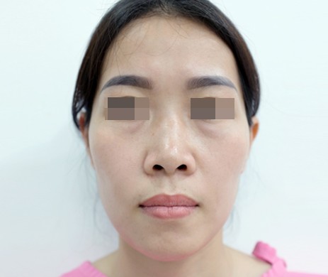 Cấy mỡ thái dương
