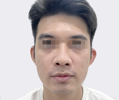 Độn cằm nam