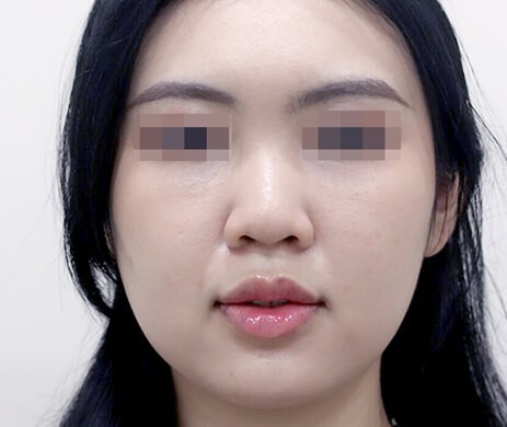 Lấy túi mỡ má