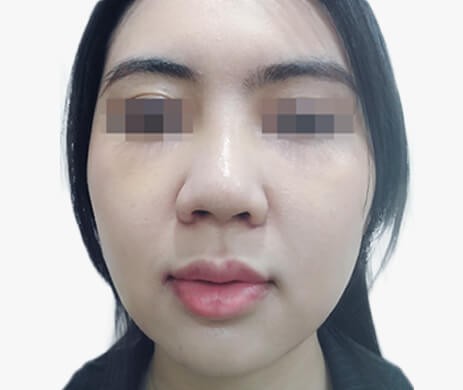 Lấy túi mỡ má
