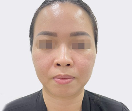 Độn cằm