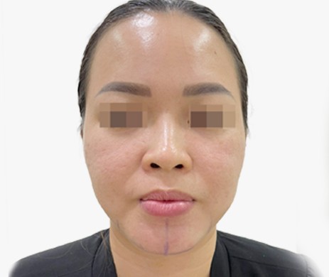 Độn cằm