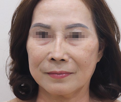 mũi lót sụn sửa lại