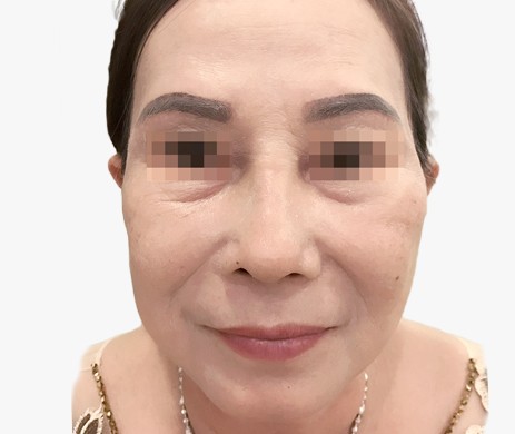 mũi lót sụn sửa lại
