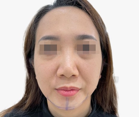 Độn cằm lẹm