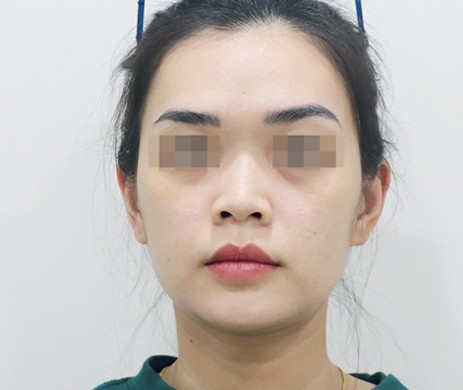 mũi lót sụn