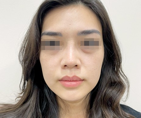 mũi lót sụn
