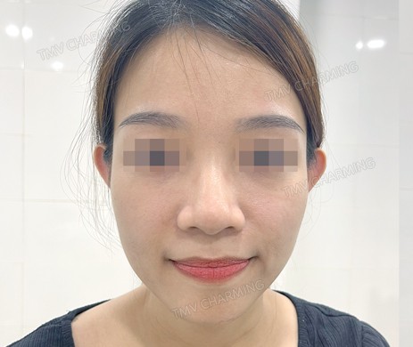 Chỉnh tai vểnh