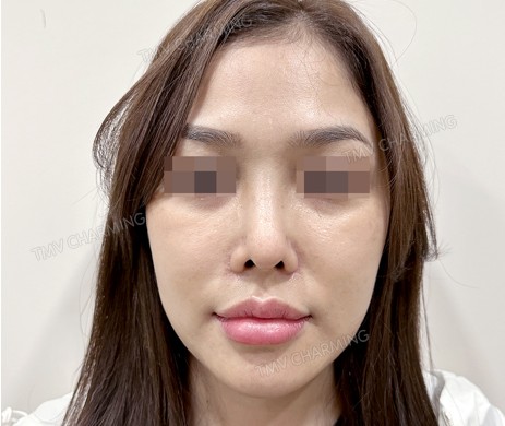 Mũi cấu trúc sụn sườn sửa lại – cắt xương – cắt cánh