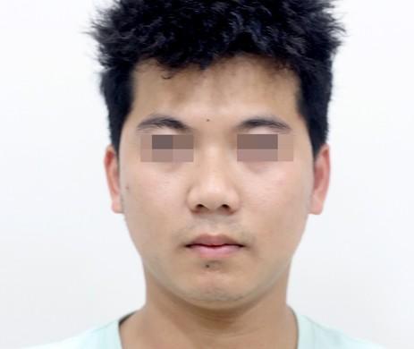 Mũi lót sụn – Độn cằm