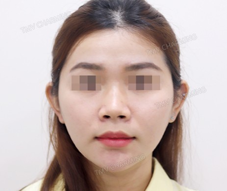 Mũi lót sụn