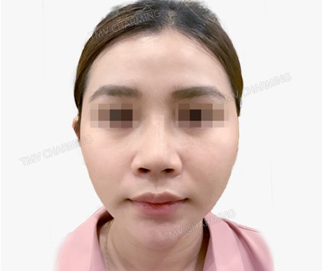 Mũi lót sụn