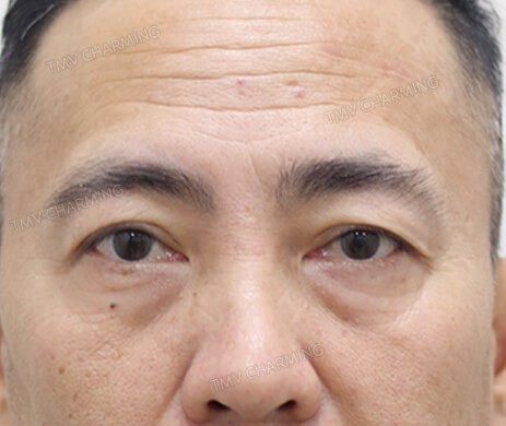 Cắt mí dưới