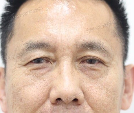 Cắt mí trên