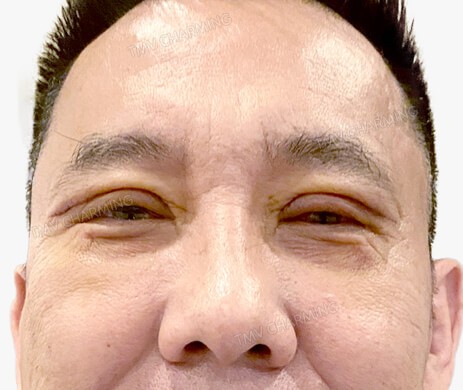 Cắt mí trên