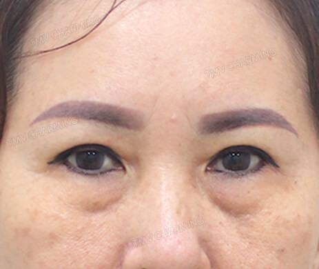 Cắt mí dưới
