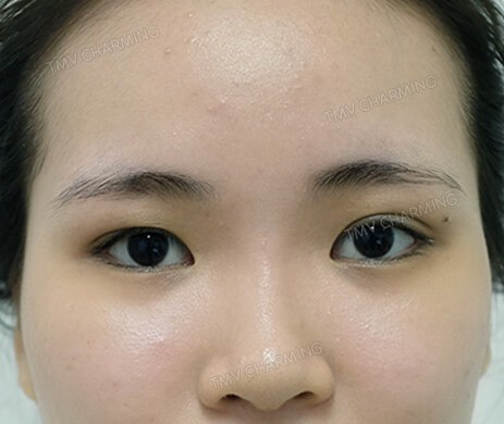 Cắt mí trên – Mở góc mắt