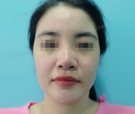 Mũi cấu trúc sụn sườn sửa lại – cắt cánh