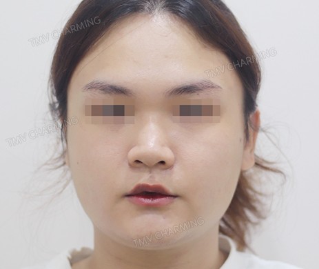 Mũi lót sụn – cắt cánh – cắt xương