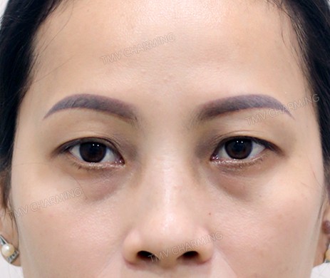 Cắt mí trên – mí dưới + cấy mỡ mí dưới