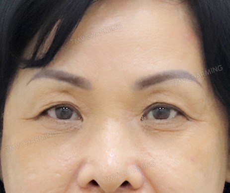 Treo cung mày