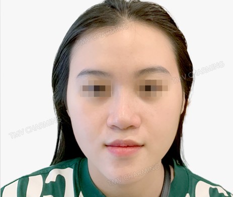 Mũi lót sụn + cắt xương + lấy chỉ