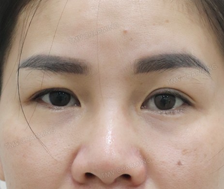cắt mí trên
