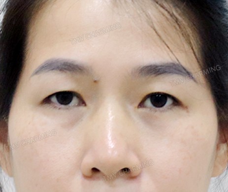 cắt mí trên