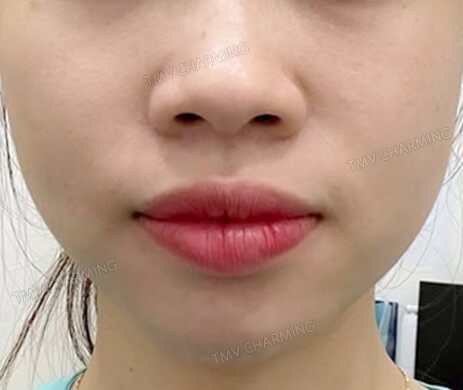 Cắt môi trên