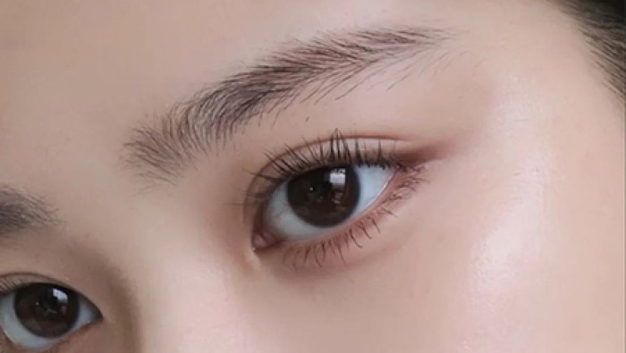 Nhấn mí mắt