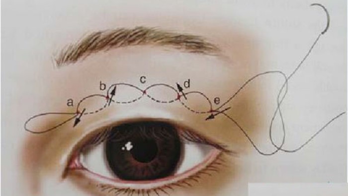 Điều cần biết về bấm mí đẹp và tự nhiên