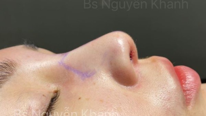 Những ai nên nâng mũi lót sụn