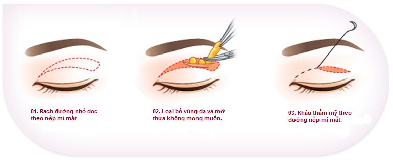 cắt da mở thừa mí trên