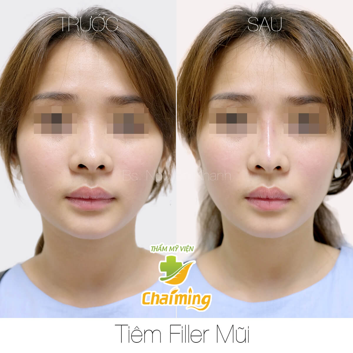 tiêm filler