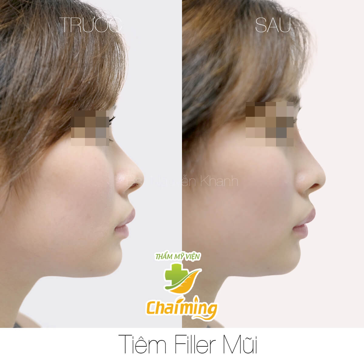tiêm filler