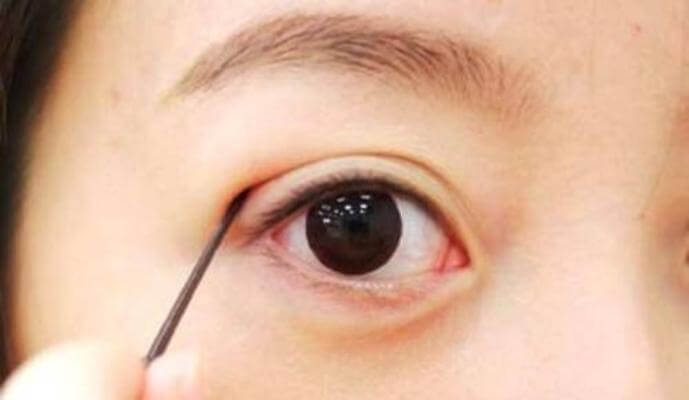 mí mắt sưng to