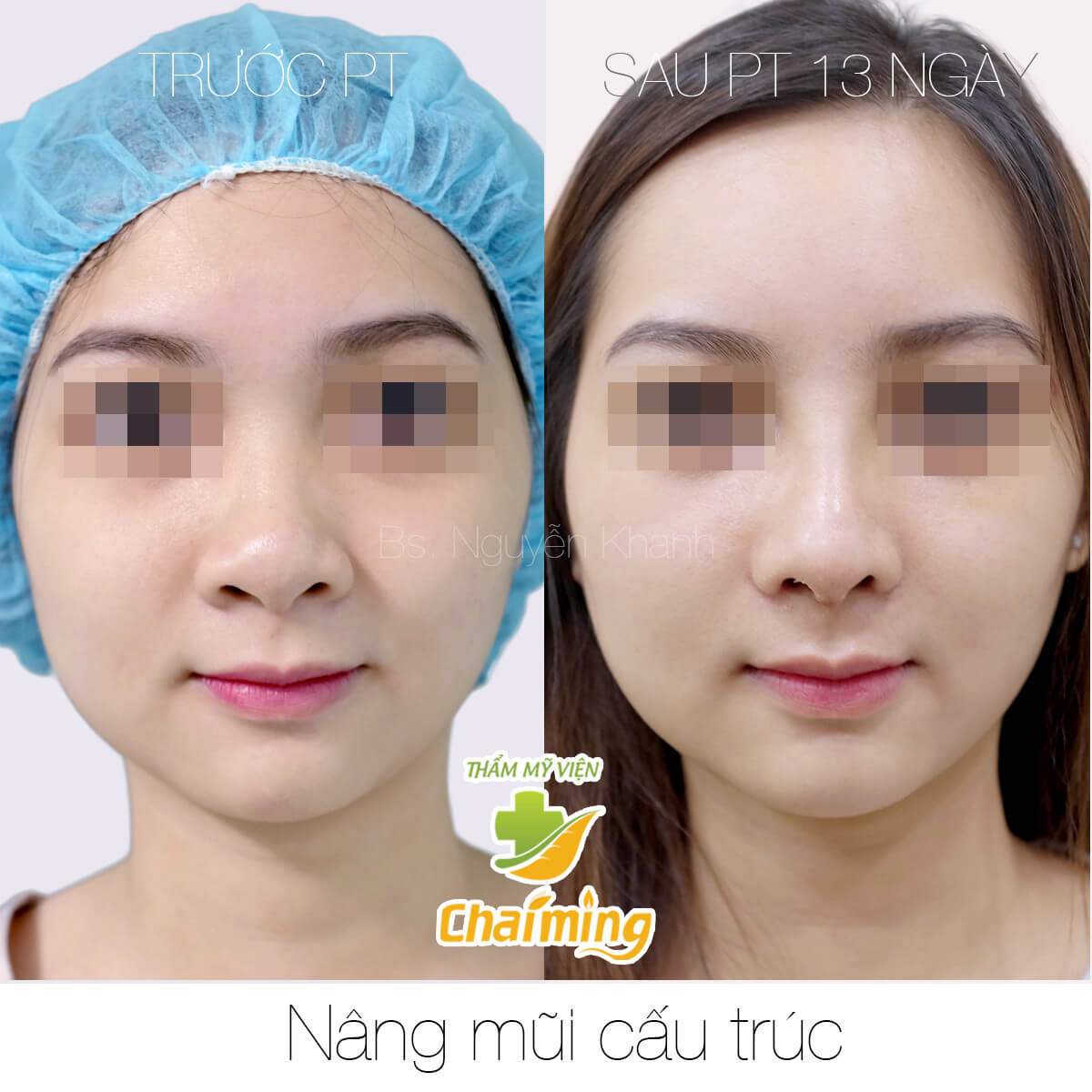 sửa mũi