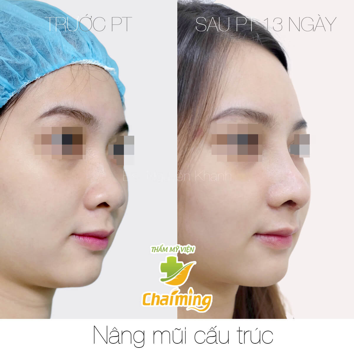 sửa mũi